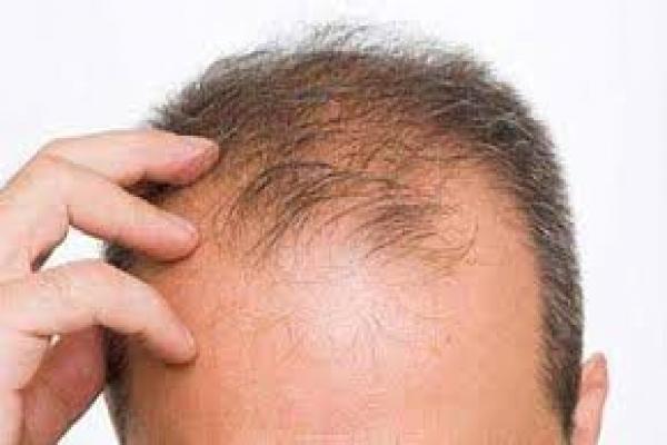 دلیل ریزش موی مردان بیشتر از زنان چیست؟